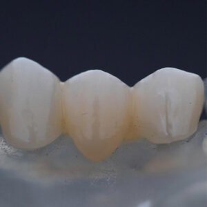 CROWNS AND BRIDGES